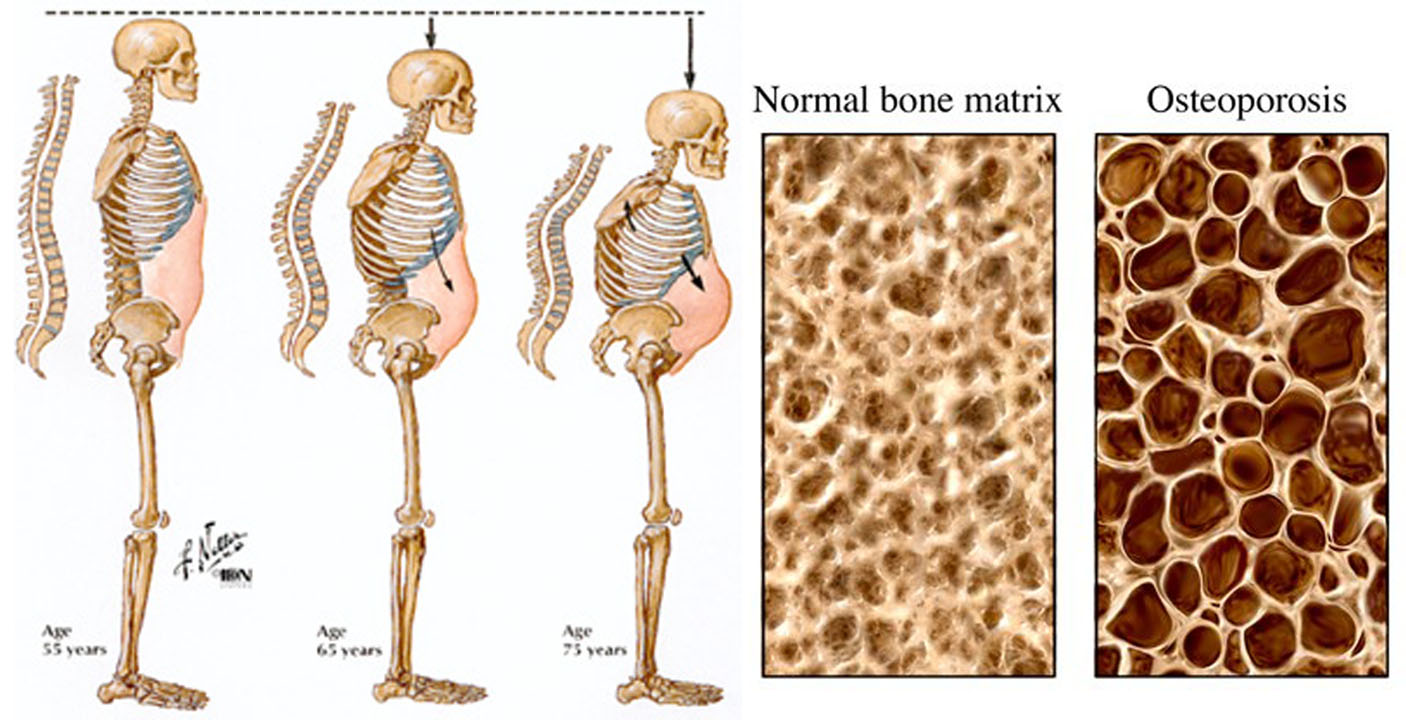 6-osteoporosis