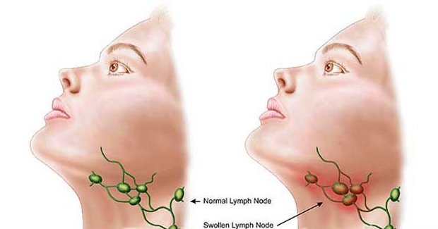 home-remedies-for-treating-swollen-lymph-nodes